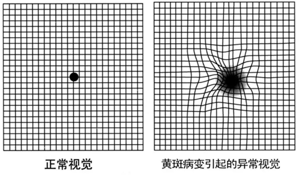 看东西发生扭曲，是什么眼?。? /></a></div>            
                             
                <div   id=